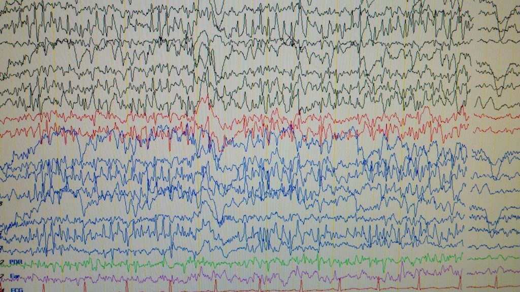 Zdjęcie przedstawia EEG biofeedback prezentowany za pomocą wykresów.