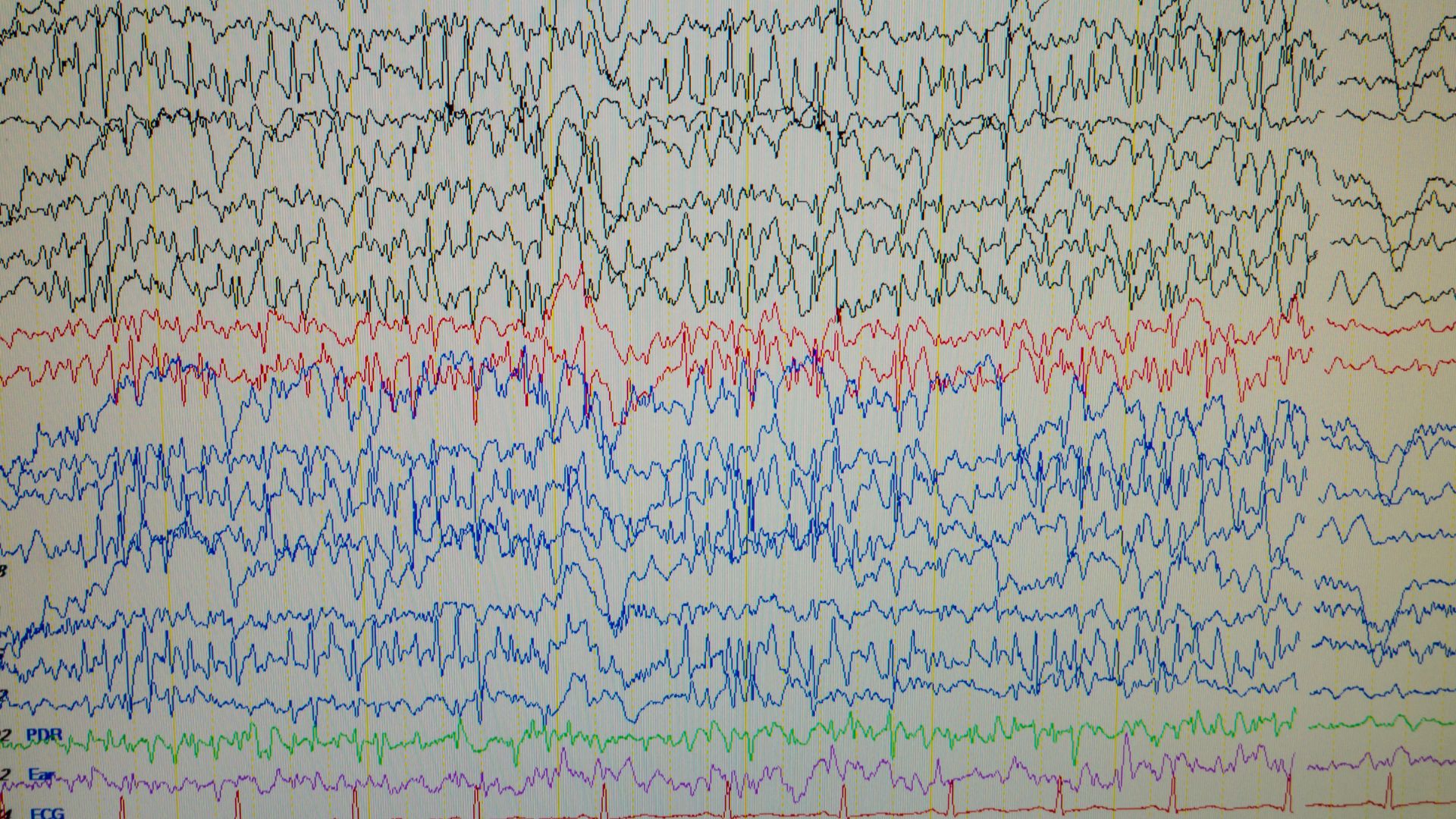 Zdjęcie przedstawia EEG biofeedback prezentowany za pomocą wykresów.